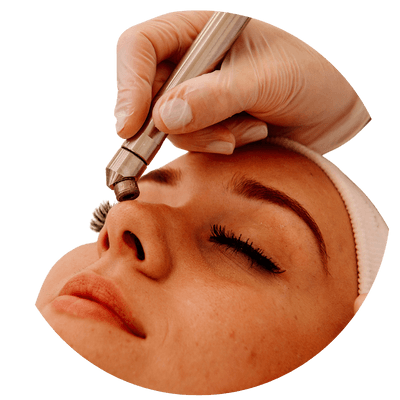 Peeling de Diamante em Belo Horizonte | New Laser Estética