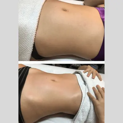 a New Laser Estética, em Belo Horizonte, oferecemos tratamentos completos de emagrecimento saudável, combinando alta tecnologia, protocolos personalizados e acompanhamento profissional. Nossos tratamentos atuam na redução de gordura localizada, definição corporal e aceleração do metabolismo, proporcionando resultados eficazes e duradouros. ✔️ Benefícios dos Tratamentos de Emagrecimento: Redução de medidas e gordura localizada Melhora no contorno e definição corporal Estímulo ao metabolismo e queima de gordura Protocolos personalizados para cada paciente Resultados seguros, rápidos e duradouros Se você busca um emagrecimento saudável, com acompanhamento profissional e tecnologia de ponta, a New Laser é referência em Belo Horizonte. Agende sua avaliação e comece hoje sua transformação!