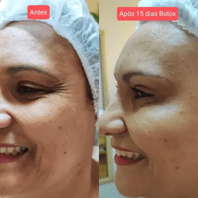 A Toxina Botulínica, popularmente conhecida como Botox, é um tratamento estético amplamente utilizado para reduzir rugas e linhas de expressão, proporcionando um aspecto mais jovem e natural ao rosto. Na New Laser Estética, em Belo Horizonte, aplicamos a toxina botulínica com segurança e precisão, garantindo resultados que valorizam sua beleza natural sem perder a expressividade facial. ✔️ Benefícios da Toxina Botulínica: Suaviza rugas e linhas de expressão Proporciona aparência rejuvenescida e natural Procedimento rápido e minimamente invasivo Resultados visíveis em poucos dias Melhora a autoestima e confiança Se você deseja um tratamento eficaz para rejuvenescer seu rosto com segurança, a Toxina Botulínica na New Laser é a escolha certa em Belo Horizonte. Agende sua consulta e descubra como renovar sua beleza com tecnologia avançada!